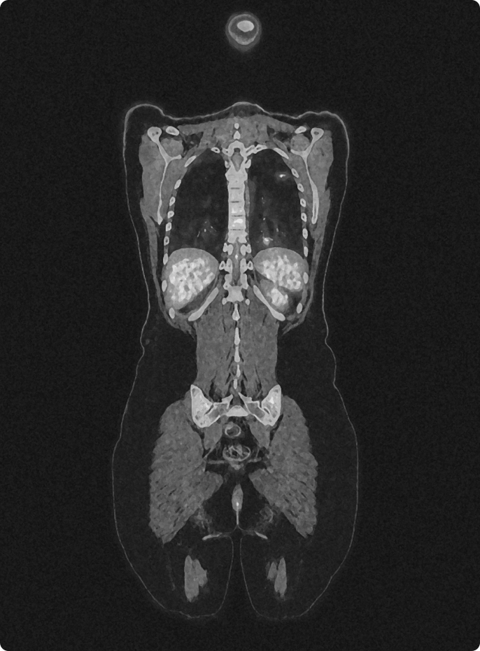 Medical PET-CT scan