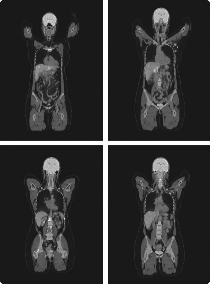 Medical PET-CT scan